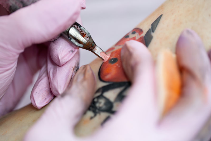 Needles placed too deeply or at an incorrect angle